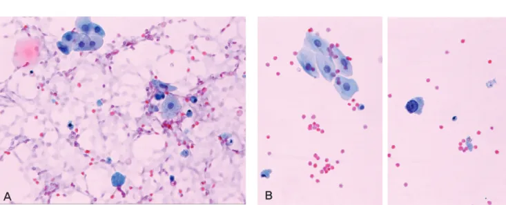 Fig. 2. Cytologic features of cell degeneration and artifact in ThinPrep ® (TP) and Cytospin (CS) with repeated urine