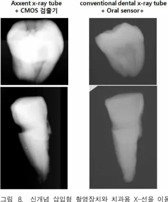 Fig. 8. The dental image using insertional X-ray system with new concept and conventional dental X-ray.