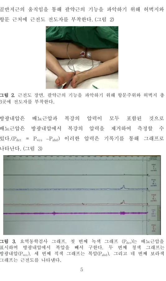 그림  3.  요역동학검사  그래프.  첫  번째  녹색  그래프  (P det )는  배뇨근압을 