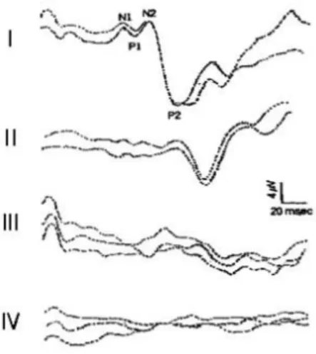 Fig.  1.  The  four  major  patterns  of  visual  evoked  potentials  are  as  follows:  I  normal  response,  II  prolonged  latency,  III  abnormal  waves,  and  Ⅳ  no  response.