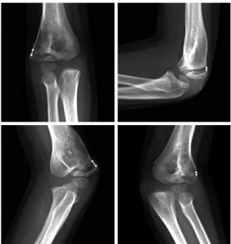 Fig. 2. Anteroposterior radiographs of the left elbow (No.  7).