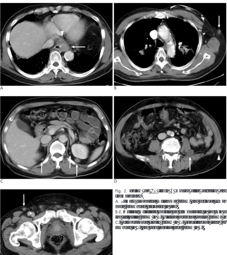 Fig. 2. Follow up CT taken 4 months after radiation and chemotherapy.