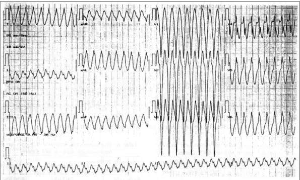 Fig. 3. Maximum preexcitation in Fig. 2 patient(wide QRS LBBB pattern). 