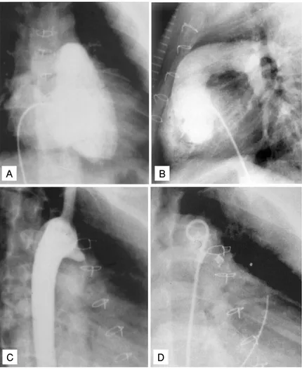 Fig. 4. Selected cineangiogram in a patient with PA and IVS who re- re-ceived surgical RVOT repair at 24 days of age and coil embolization at 5 years of age