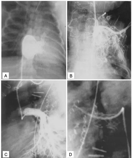 Fig. 5. Selected cineangiogram in a patient with PA and IVS who received coil embolization before and immediately after TCPC, and later received stent implantation 12 months after the procedure