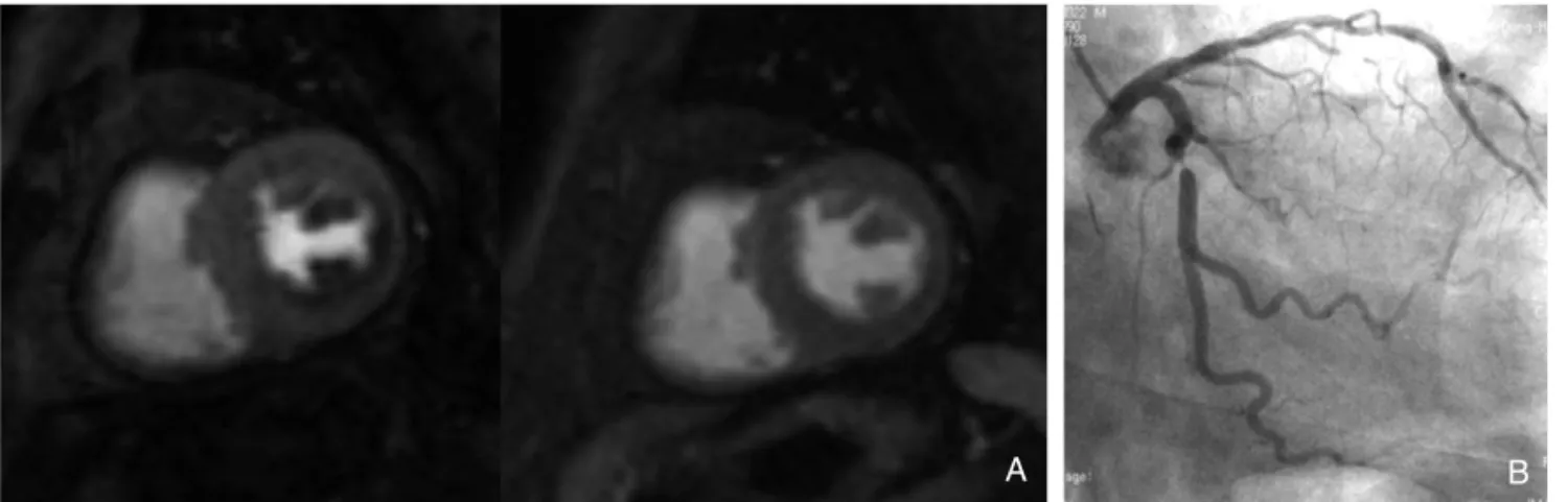 Figure 2. First-pass perfusion image acquired at 3 tesla magnetic resonance imaging (MRI)