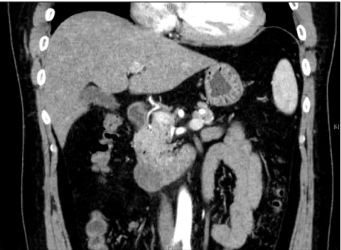 Fig.  3.  Follow-up  abdominal  CT  finding.  The  size  of  intra-