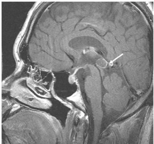 Fig.  1.  Brain  MRI,  sagital  view,  shows  12.7