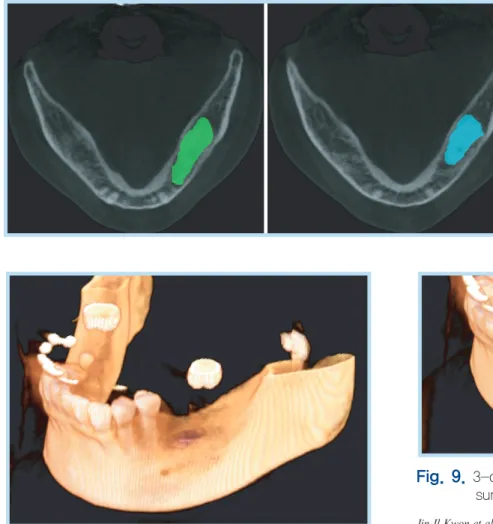 Fig.  7.  1-month  CT  evaluation  (Method  A),  axical  cut  surface (Green). 6-month  CT evaluation (Method A),  axial cut surface (Blue).
