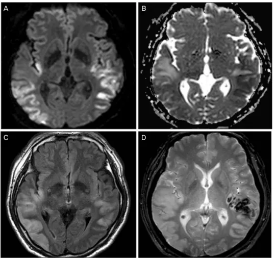 Figure 1. Diffusion-weighted MRI 