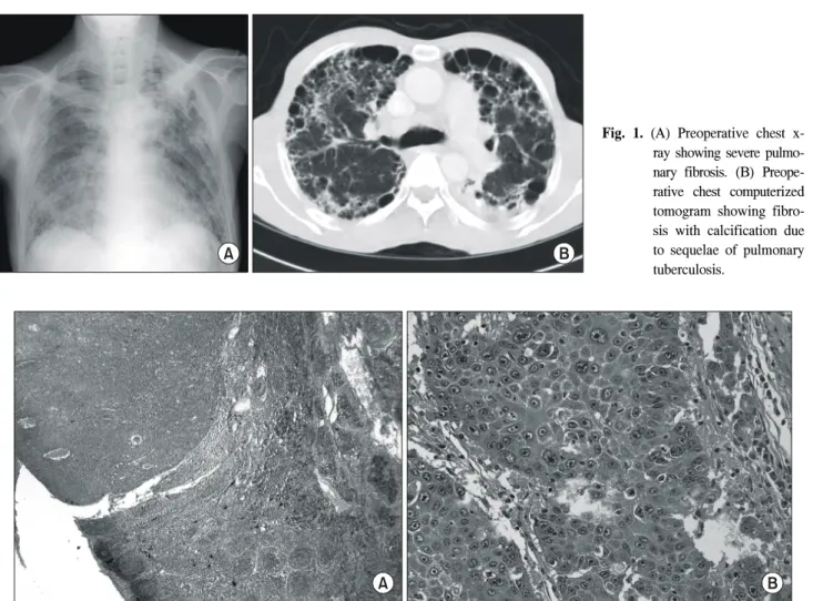 Fig.  2.  (A)  Subcarinal  lymph  node  metastasis  of  squamous  cell  carcinoma  (H&amp;E,  ×10)