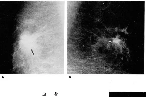 Fig.  1.  Same  location  and  mammo- mammo-graphic  findings  of  bilateral  breast  cancer 
