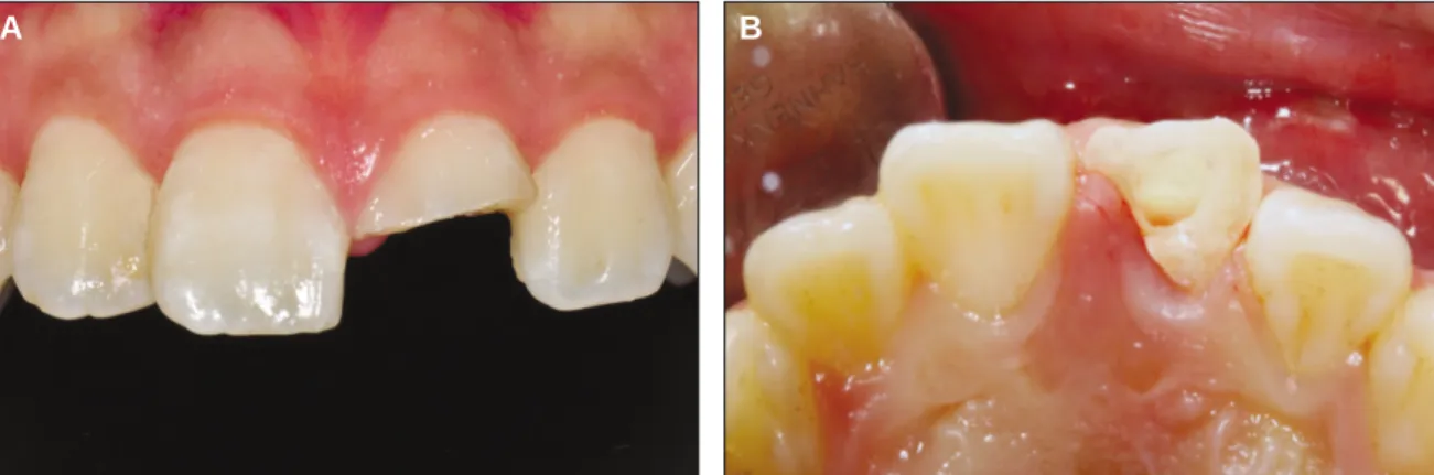 Fig. 1. A: Periapical radiograph at first visit. Pulp exposure is evident due to the