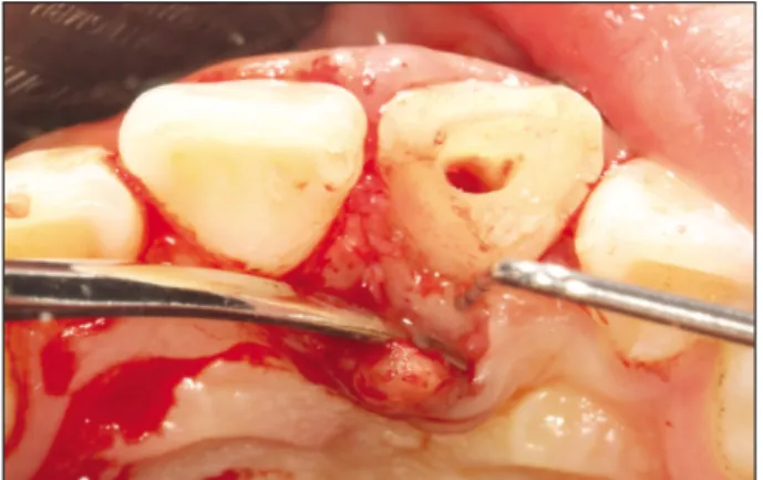 Fig. 4. The tooth is extruded approximately 3 - 4 mm and fixed only by means