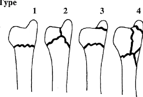 Fig.  1.  Line  diagram  depicting  morphological  types  of  distal  ulnar  fractures according to the Biyani classification