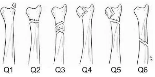 Fig. 2. In the Comprehensive Classification of Fractures, fractures  of the distal ulna associated with fractures of the distal radius are  classified according to a Q modifier 