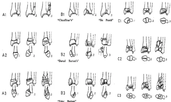 Fig. 3. AO classification of distal radius fracture 