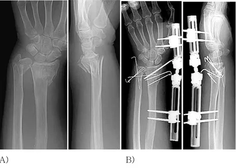 Fig.  5-A,B.  Preoperative  (A)  and  postoperative  (B)  antero-  posterior and lateral wrist X-ray of 62 years old female patient with  AO type B2 fracture of distal radius and Biyani type II fracture of  distal ulna 
