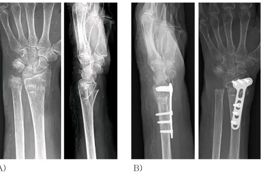 Fig. 7-A,B. Preoperative (A) and postoperative (B) antero- osterior  and lateral wrist X-ray of 75 years old female patient with AO type  A3 fracture of distal radius and Biyani type IV fracture of distal ulna 