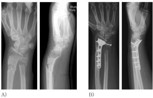 Fig. 8-A,B. Preoperative (A) and postoperative (B) antero- osterior  and lateral wrist X-ray of 23 years old female patient with AO type  A3 fracture of distal radius and Biyani type IV fracture of distal ulna 