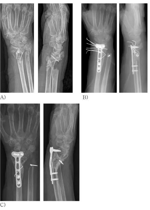 Fig. 9-A,B,C. Preoperative (A), postoperative (B) and after 1 year  from operation (C) antero-posterior and lateral wrist X-ray of 78  years old female patient with AO type C2 fracture of distal radius  and Biyani type IV fracture of distal ulna 