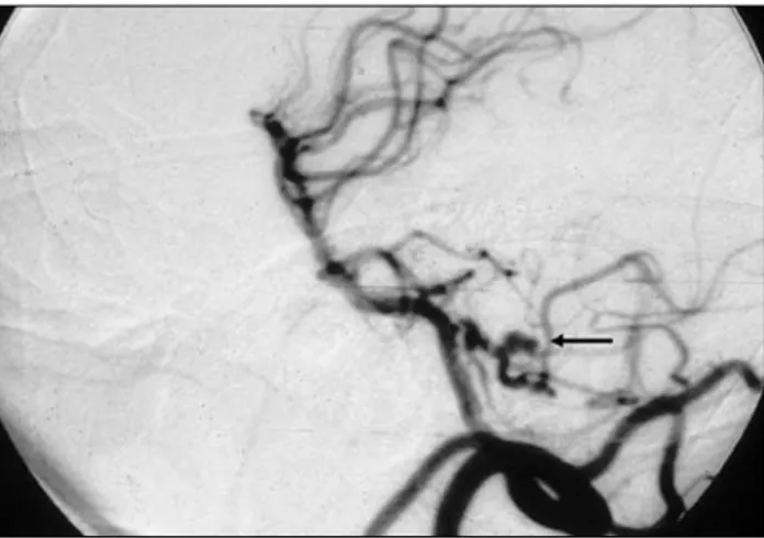 Fig. 1. The vertebral angiogram of a 64-years-old woman with subarachonoid  hemorrhage  of  Fisher  grade  3  on  admission shows PICA aneurysm in lateral medullary segment