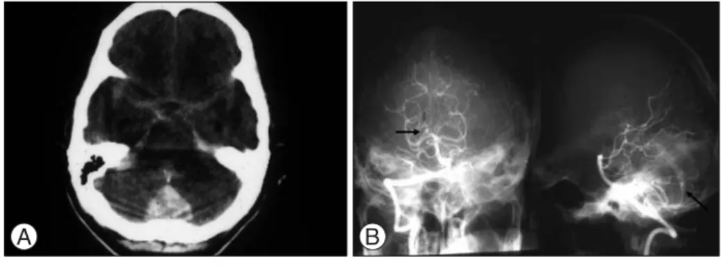 Fig.  4. A : Brain CT image of a 57- 57-years-old woman shows subarachnoid hemorrhage  with  intraventricular hemorrhage within fourth ventricle