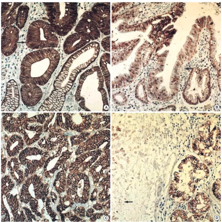 Fig. 2. The immunohistochemical stain for E-cadherin in gastric adenomas shows the same or increased (in this figure, increased) mem- mem-branous expression (arrow) pattern compared to normal gastric mucosa (open arrow) (A) and decreased memmem-branous exp