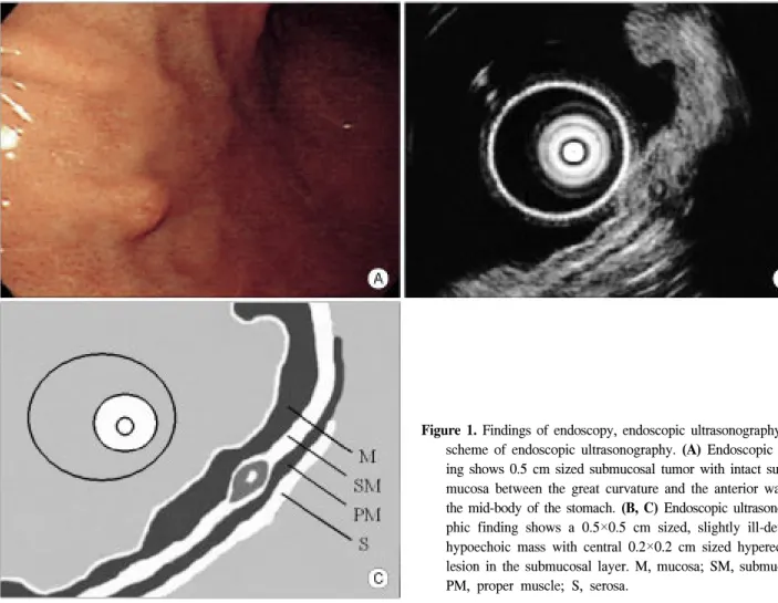 Figure  1.  Findings  of  endoscopy,  endoscopic  ultrasonography  and  scheme  of  endoscopic  ultrasonography