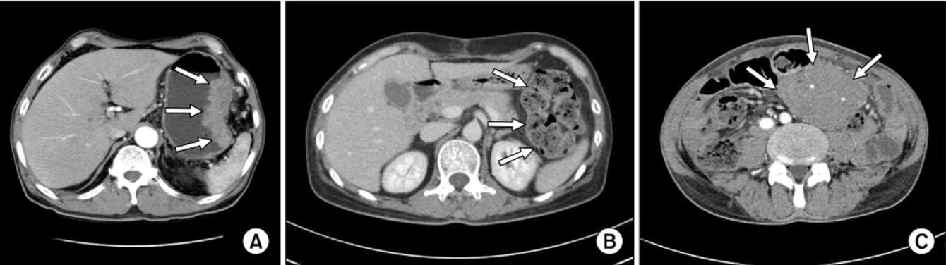 Fig. 1. Abdomen-pelvic CT findings of primary GI T-cell lymphoma. (A) Gastric T-cell lymphoma