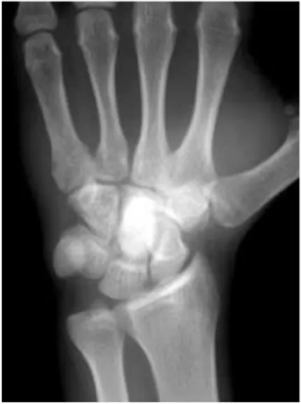 Fig. 2. Technetium 99 scintigraph shows markedly increased uptake of radionuclide by left wrist centered in area of capitate.
