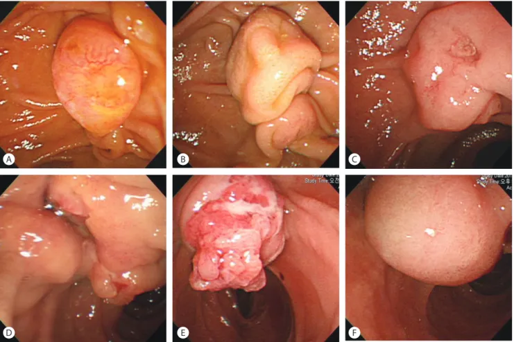 Fig. 1.  Endoscopic appearance of various ampullary tumors. (A) Ampullary adenoma, (B) choledochocele