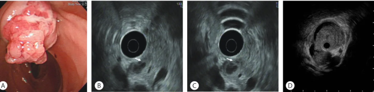 Fig. 2.  The role of Endoscopic ultrasound (EUS) and IDUS for ampullary tumor. (A) Endoscopic appearance of ampullary cancer