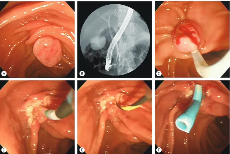 Fig. 3.  Endoscopic papillectomy. (A) 2 cm sized flat adenoma on ampulla of Vater. (B) Normal appearance of common bile duct and main pancreatic  duct on endoscopic retrograde cholangiopancreatography (ERCP)