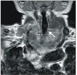 Fig.  2.  A  CT  scan  shows  encasement  of  Rt.  common  carotid  artery, 