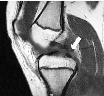 Fig. 2. A stress view shows 17 mm side-to-side difference with posterior drawer.