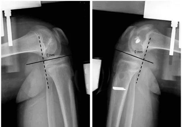 Fig. 4. Postoperative stress view shows 0 mm side-to-side difference with posterior drawer.