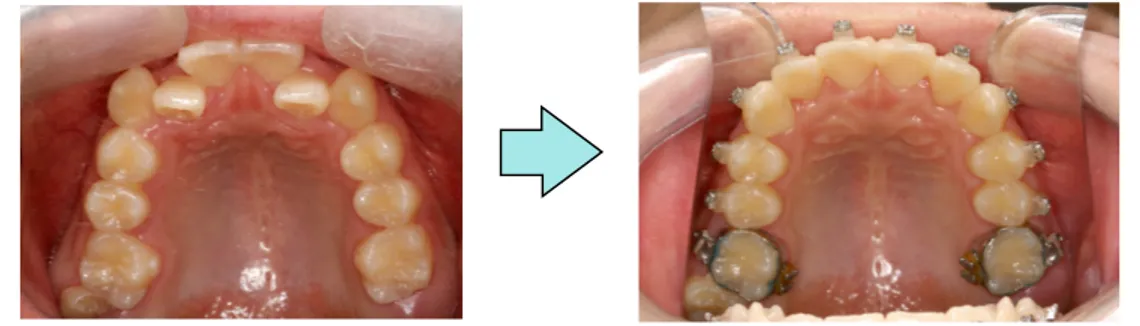 Figure  1.  Intra-oral  photo  of  the  initial  leveling  and  alignment