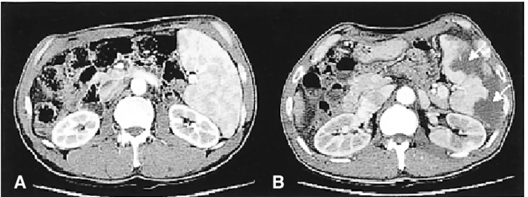 Figure  2.  CT  scans  before  and  after  partial  splenic  embolization  (PSE).  Before  PSE  (A),  splenomegaly  with  uniform  enhancement  is  seen,  and  after  PSE  (B)  the  geographic  lesions  (arrows)  resulting  from  necrosis  are  shown