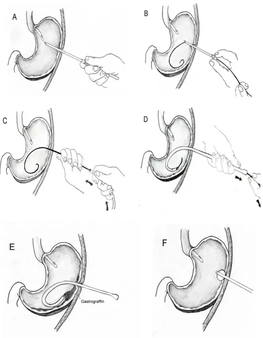 Fig. 2. Schematic diagram of gastrostomy tube reinsertion using modified Seldinger’s method A) Large-bore arrow catheter needle was inserted percutaneously vertical to the  lumen of the distended stomach
