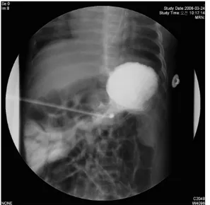 Fig. 3. Small amount of gastrograffin was  injected through the newly inserted  gastro-stomy tube to confirm the position of the  catheter in the lumen of the stomach
