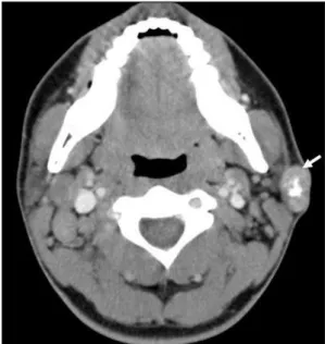 Fig. 1. Computed tomographic findings of mass in left periauri-