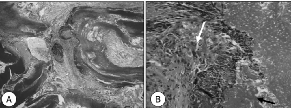 Fig. 4. Pathologic findings of case 2. A：In lower power view, it is composed of several cystic structures with keratin lake(H &amp; E  ×40).