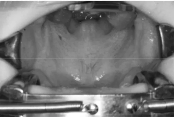 Figure 1. Bifid uvula was not found on the pre-operative clinical photo of the case.