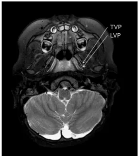 Figure 4. Intra-operative clinical photo of the case. Note the dissection of LVP from the hard palate.