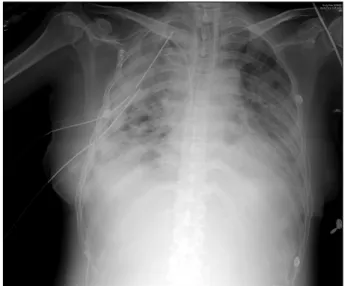 Fig. 1. A  chest  radiograph  showed  bilateral  diffuse  patchy  opacities 