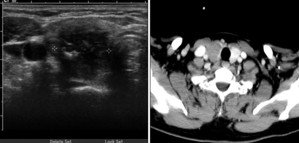 Fig. 1. Neck U/S and CT show that 4×2cm sized hypoechoic mass is noted in right thyroid without lateral neck node enlargement.
