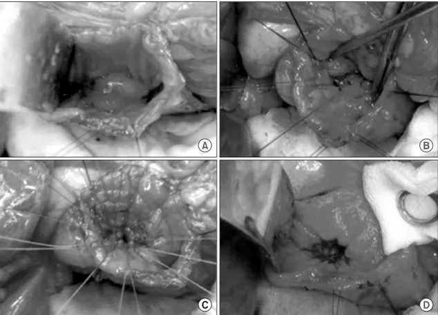 Fig.  1.  Surgical  techniques  of  transduodenal  local  resection.  (A)  After  Kocherization  of  duodenum,  stay  sutures  are  placed  and  a  longitudinal 