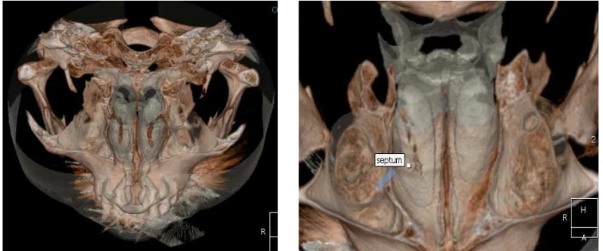 Fig.  5.  3D-image  of  skull Fig.  6.  3D-image  of  septum