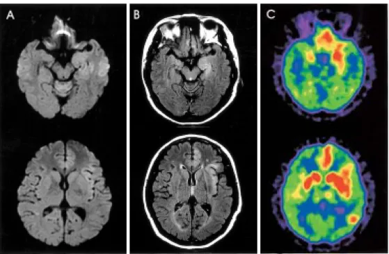 Figure 1. (A) DWI in brain MRI. Increased SI was noted in limbic structure prominently in left side